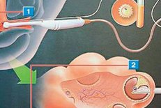 疤痕子宫缺陷可以做试管吗？